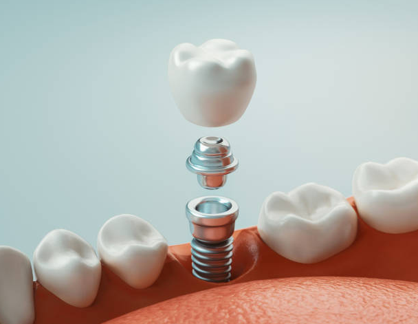 Are Dental Implants Free In Sweden?