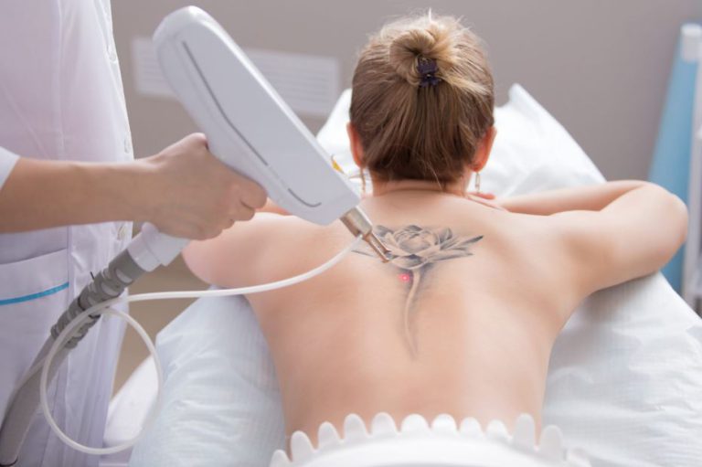 How Much Does Laser Tattoo Removal Cost In The United Kingdom
