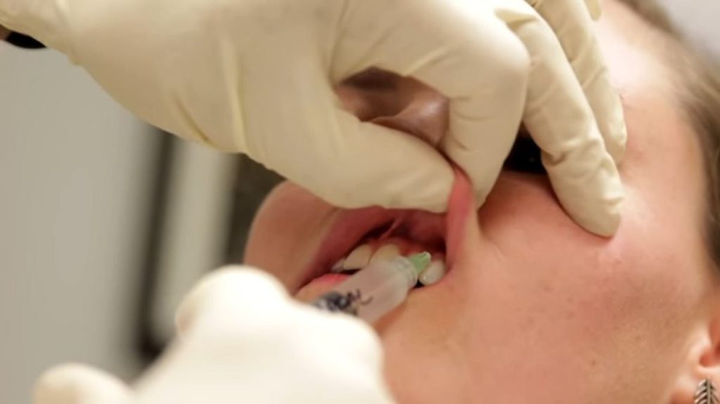 How Much Are Lip Injections? How Long Do They Last?